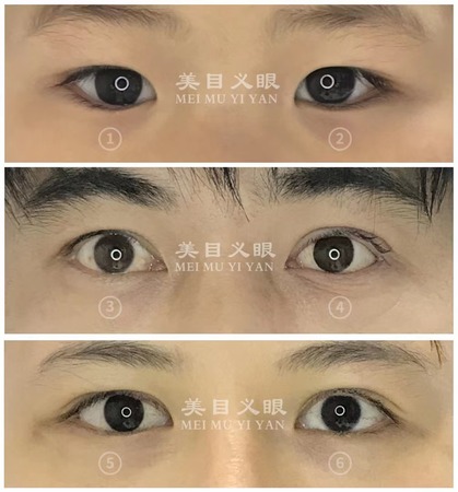 猜义眼01